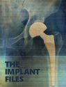 The Implant Files